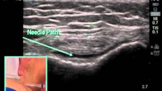 How to Ultrasound Guided Knee Injection Scanning Technique [upl. by Smoht]