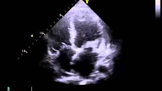 Echocardiography to Assess MitralValve Leaflets  NEJM [upl. by Oirrad]