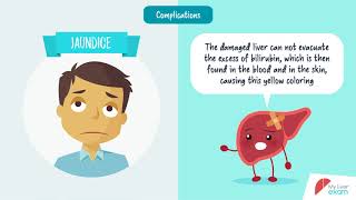 What is liver cirrhosis [upl. by Akerue]