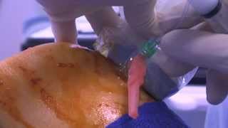 WATCH a Knee Joint Injection  LIVE [upl. by Chiou]