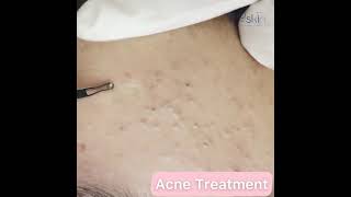 Comedone Extraction Acne Treatment [upl. by Fishman79]