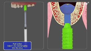 CAS KIT Crestal Approach  Sinus KIT [upl. by Keelia]