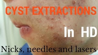 Cysts extractions blackheads  Removal methods in HD [upl. by Corin]