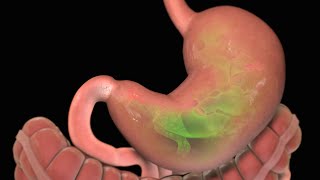 Stomach Ulcer  Nucleus Health [upl. by Ainedrag]