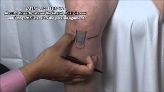 Knee Injection  Anterior Approach [upl. by Adnalay]