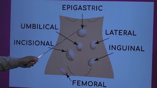 Types of Hernia [upl. by Aisya949]