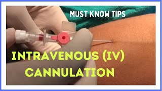 INTRAVENOUS IV CANNULATION in 5 mins How to insert [upl. by Gorlicki]