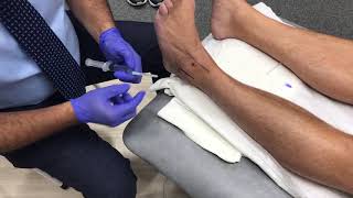 Ankle Steroid injection [upl. by Reffineg]